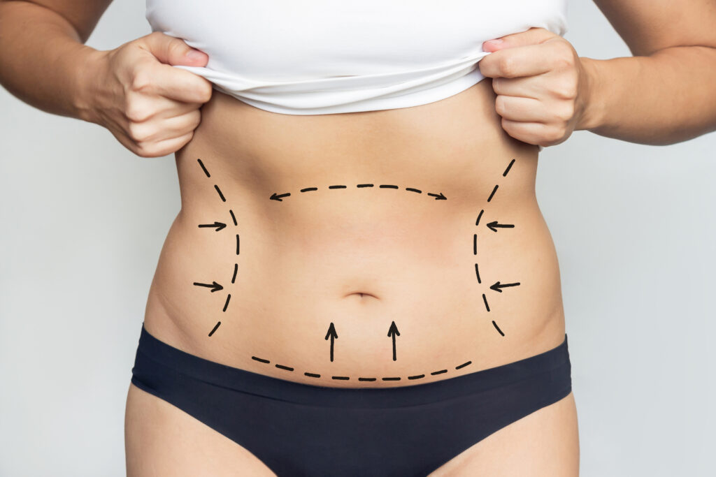 PERDIDA DE GRASA LIPO