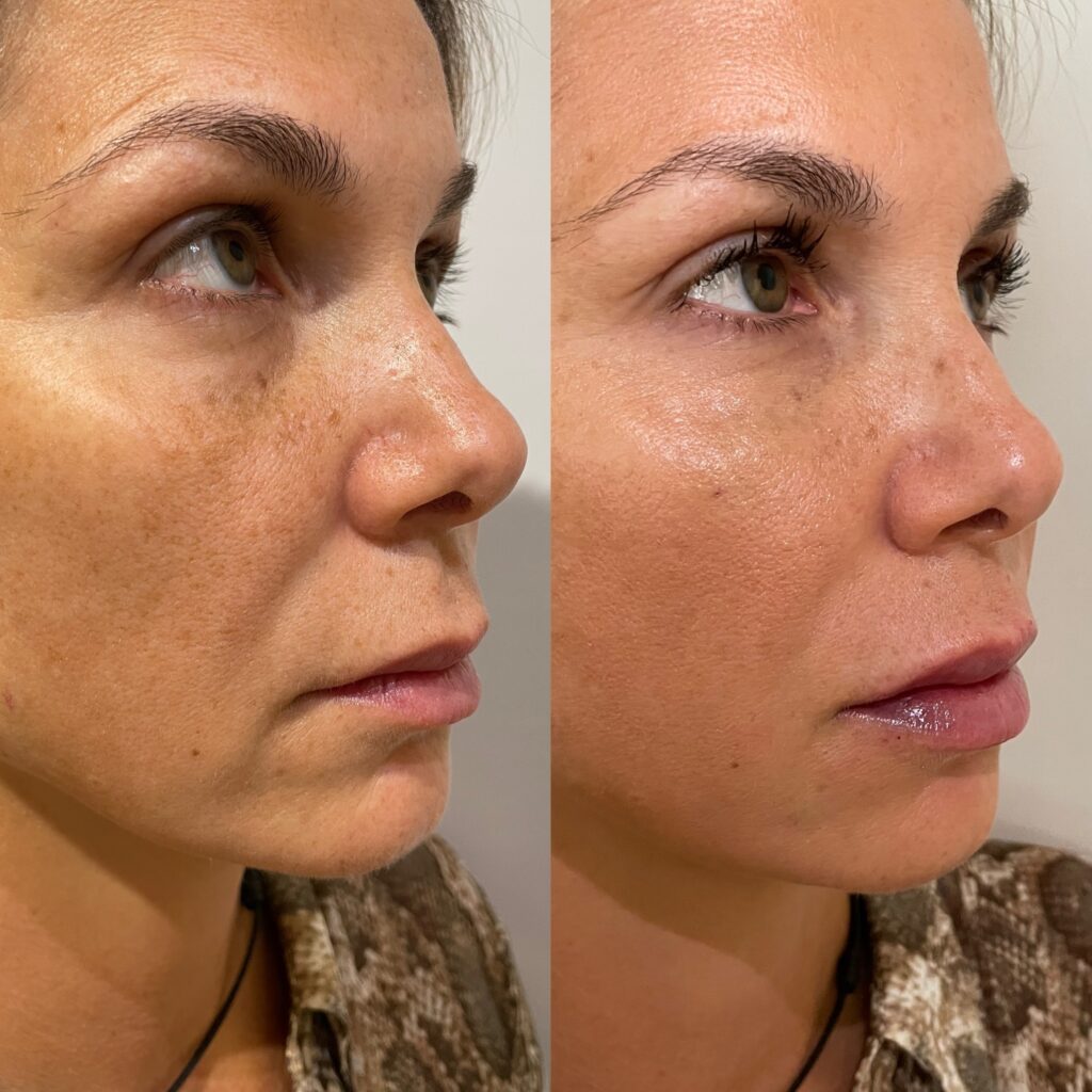 MEDICINA ESTÉTICA EN BLANES​ - CORPO BALANCE
